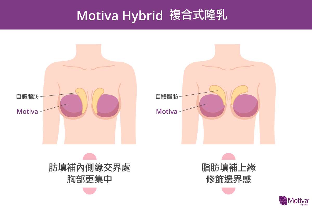 波力媚(俗稱魔滴)複合式隆乳