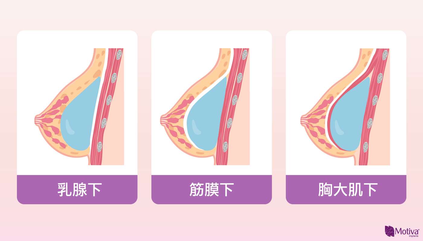 波力媚(俗稱魔滴)隆乳手術放置位置
