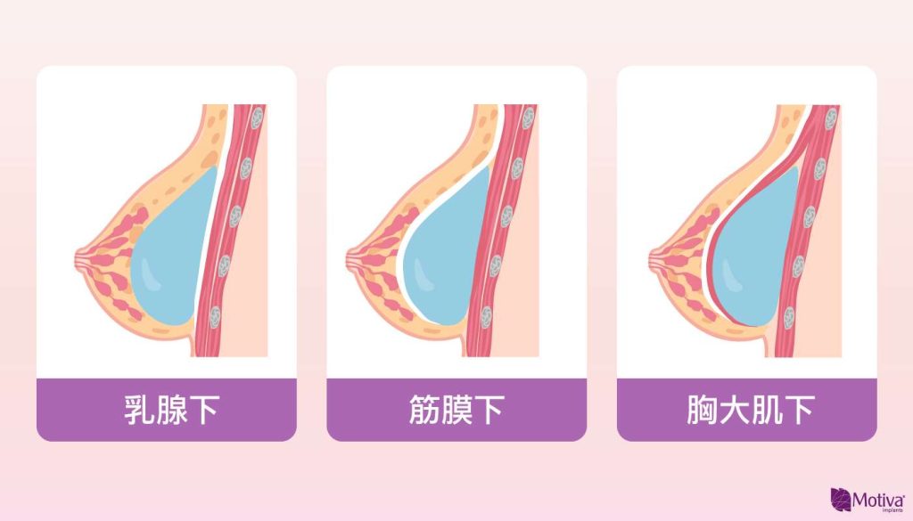 魔滴放置位置
