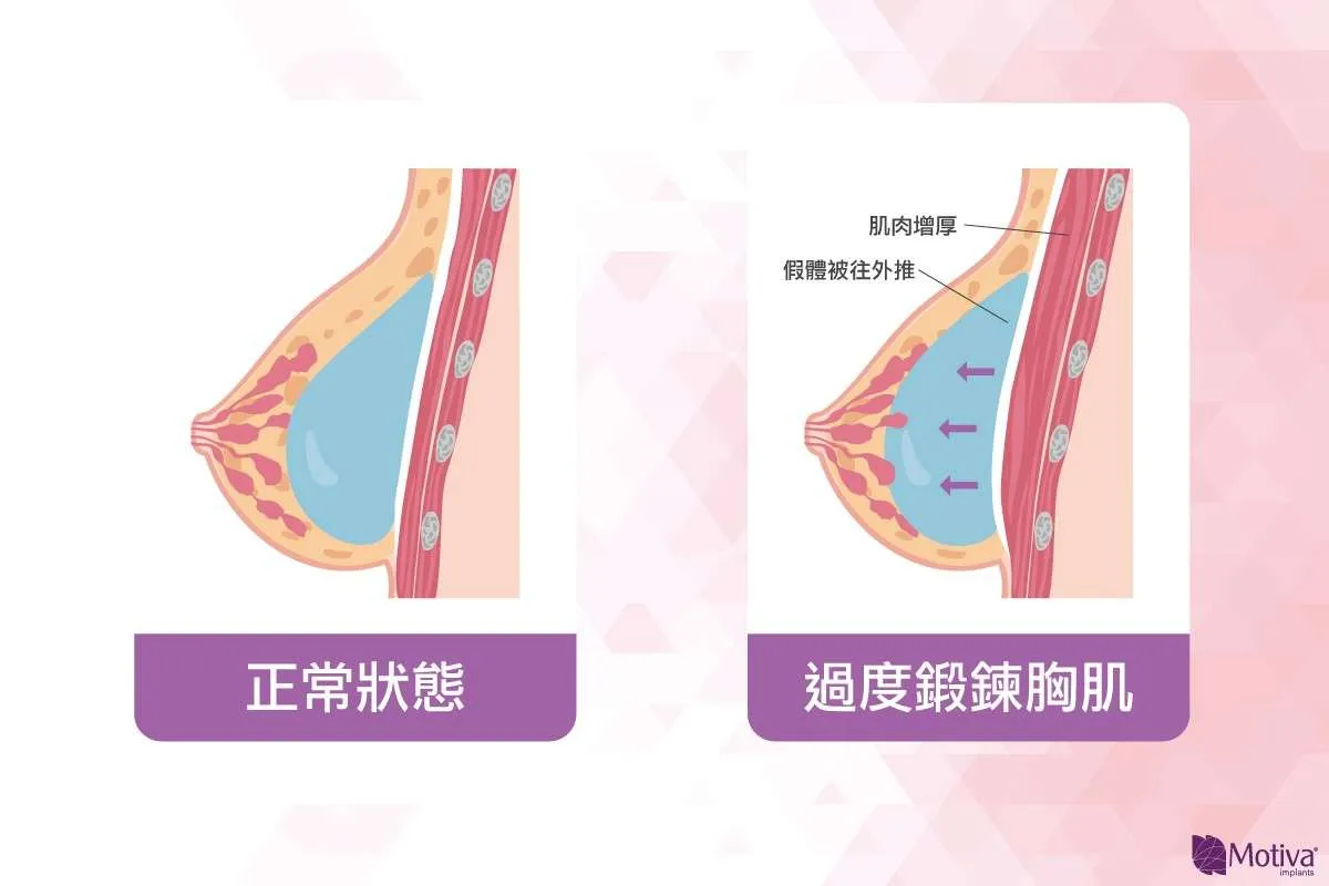 隆乳重訓與否的胸部變化