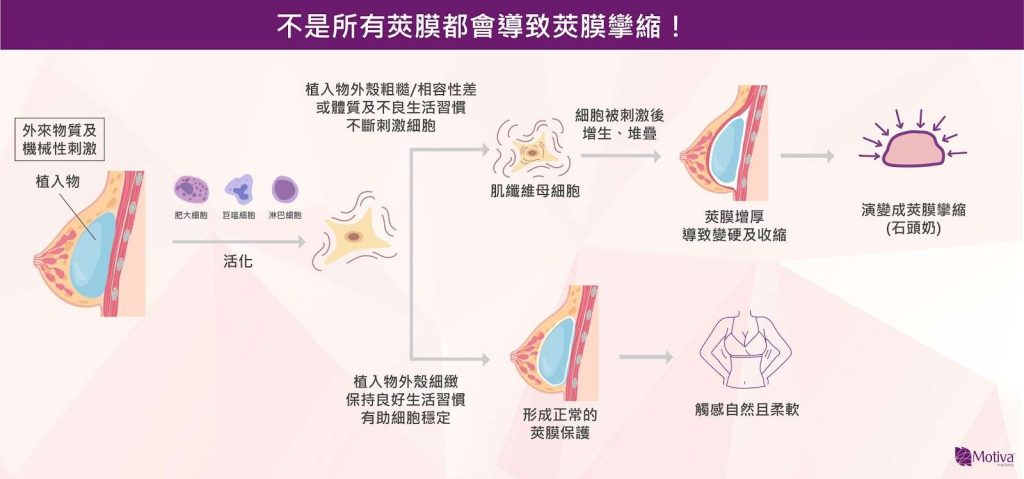 隆乳後不一定都會莢膜攣縮