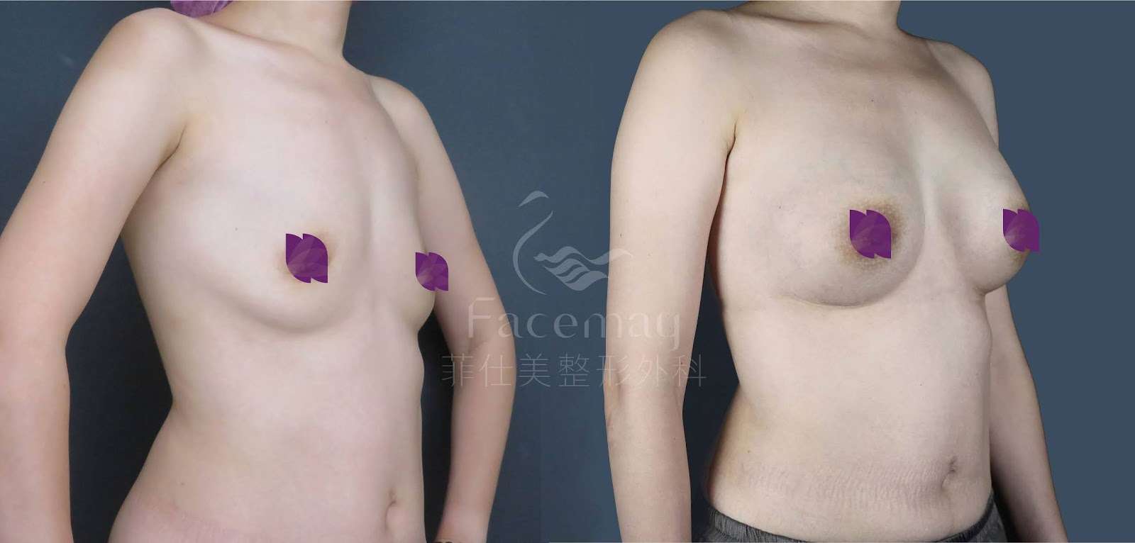 Motiva波力媚(俗稱魔滴)隆乳術前術後比較