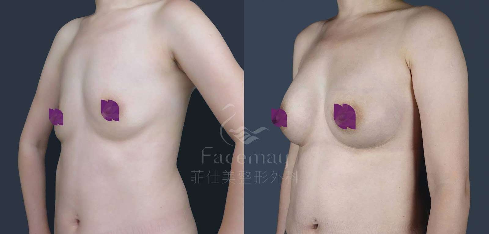 Motiva波力媚(俗稱魔滴)隆乳術前術後比較