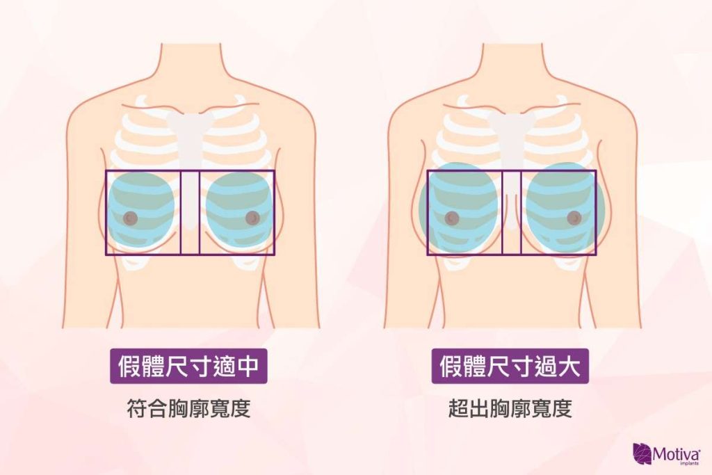 Motiva波力媚(俗稱魔滴)假體尺寸比較