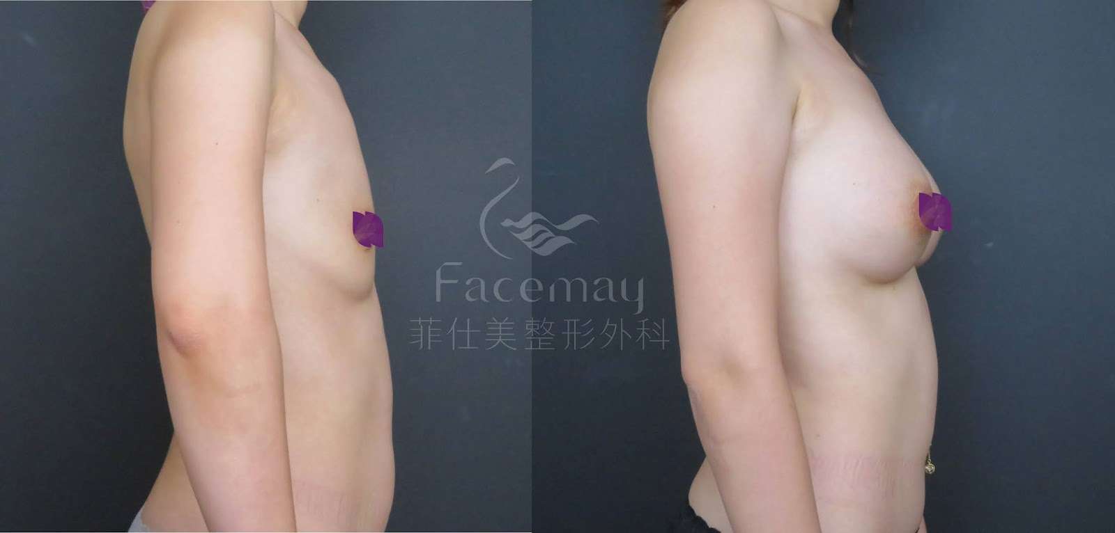 Motiva波力媚(俗稱魔滴)隆乳術前術後比較