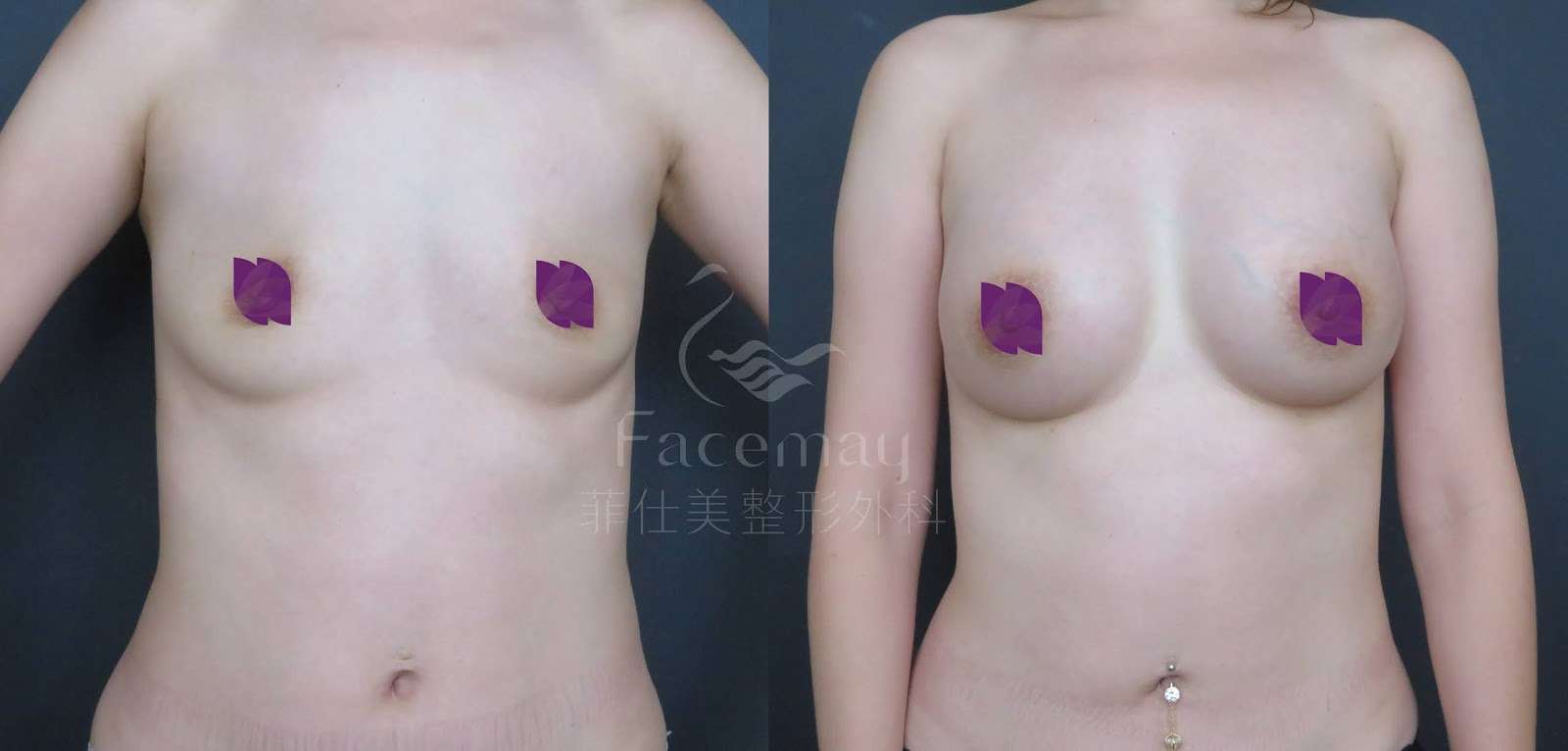 Motiva波力媚(俗稱魔滴)隆乳術前術後比較
