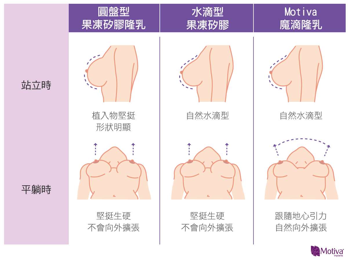 不同隆乳方式在不同情境的比較