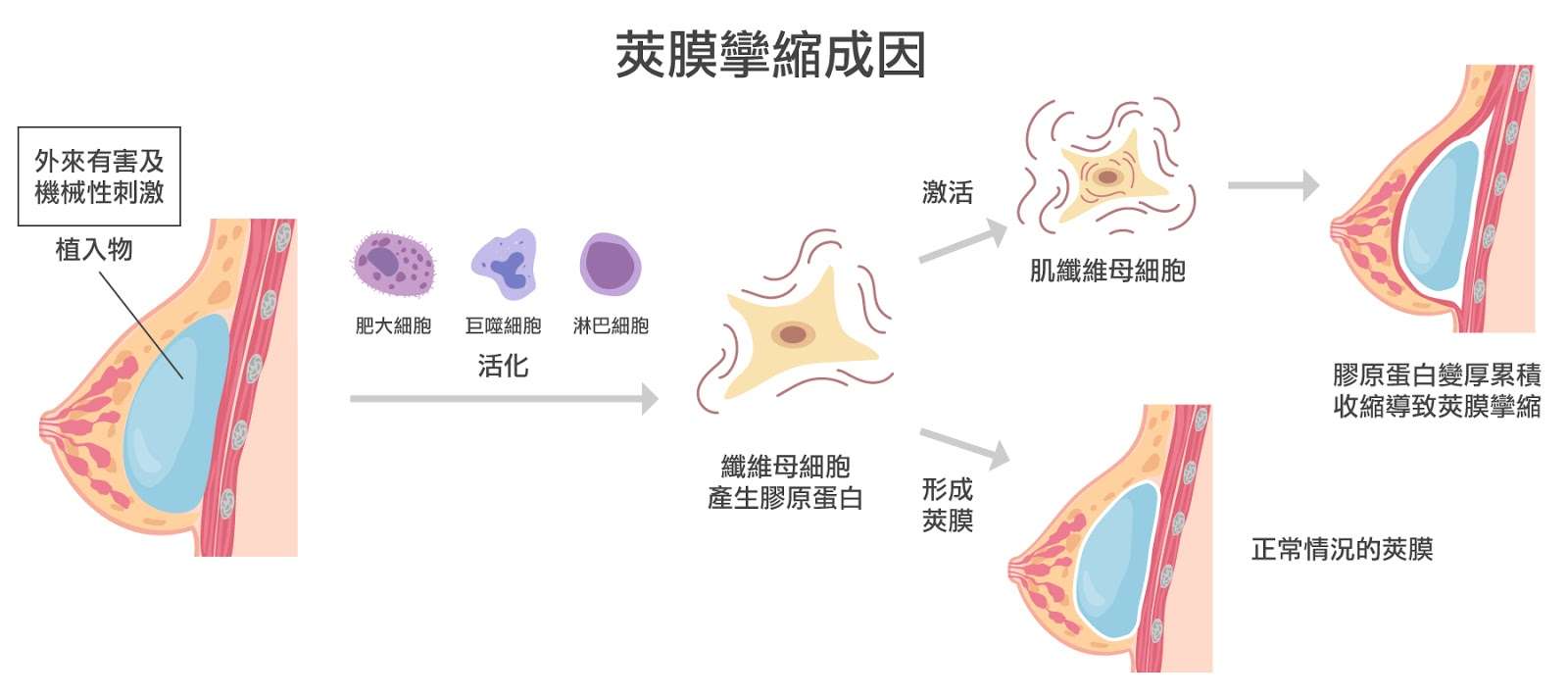 莢膜攣縮成因