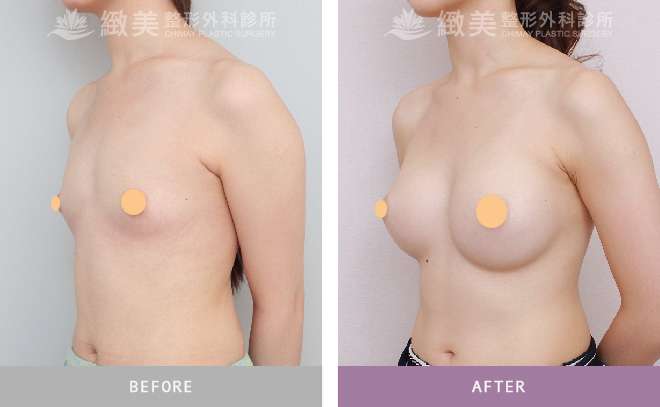魔滴隆乳分享案例自然水滴狀