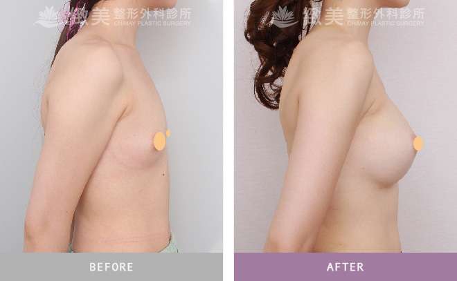 魔滴隆乳手術後效果自然