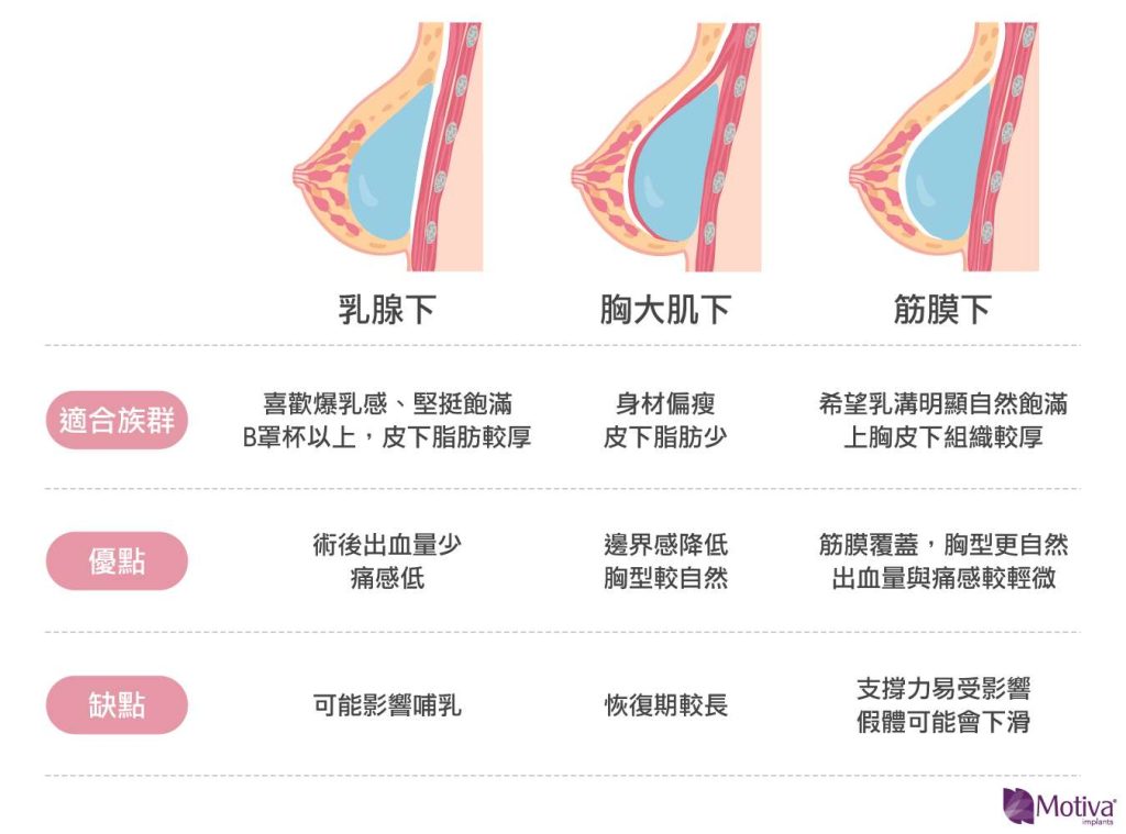 Motiva魔滴隆乳植入放入位置