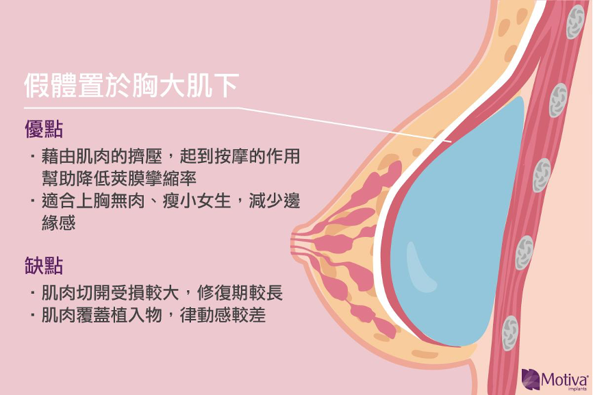 隆乳放胸大肌下的優缺點