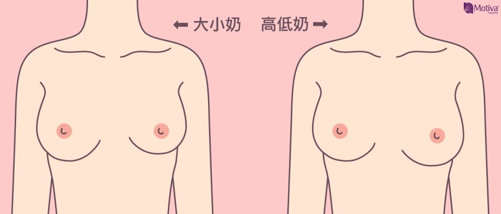 乳房不對稱