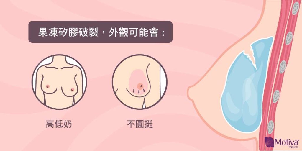 膠體破裂外觀