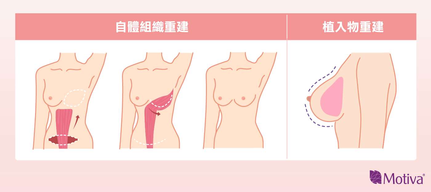 乳房重建方式「自體組織重建」、「植入物重建」