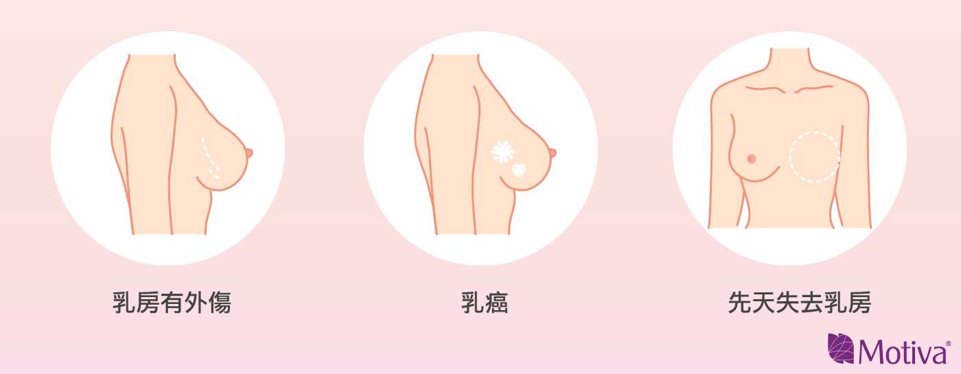 重建原因：乳房有外傷、罹患乳癌或乳房有先天性缺損等發育問題的女性