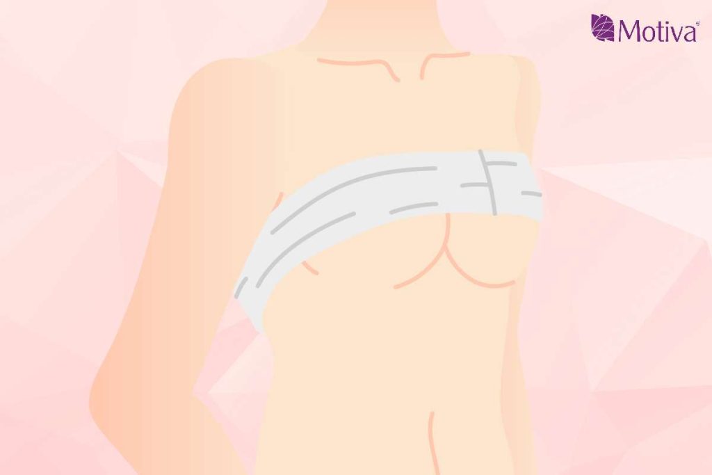 做完隆乳手術的72小時內，建議穿著固定胸型的胸帶或專用內衣都不要脫下，才能避免隆乳植入物移位