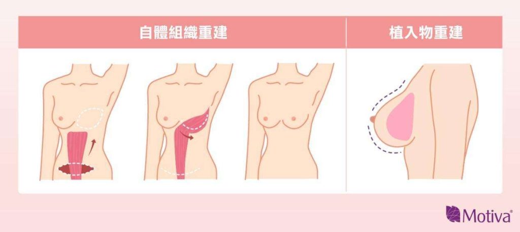 自體組織重建 植入物重建