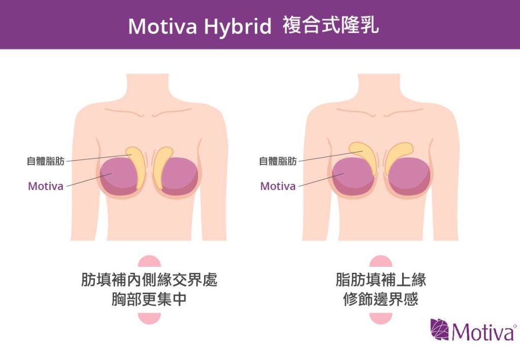 魔滴隆乳搭自體脂肪圖說