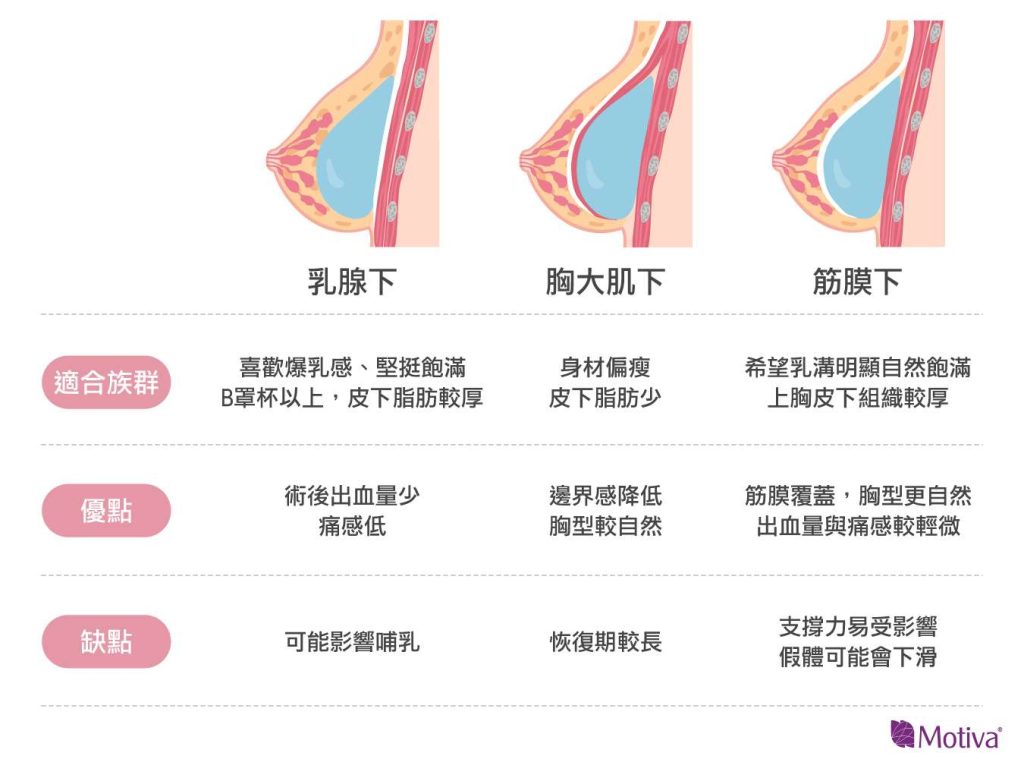隆乳手術魔滴放在胸大肌、筋膜下、乳線下的圖說 