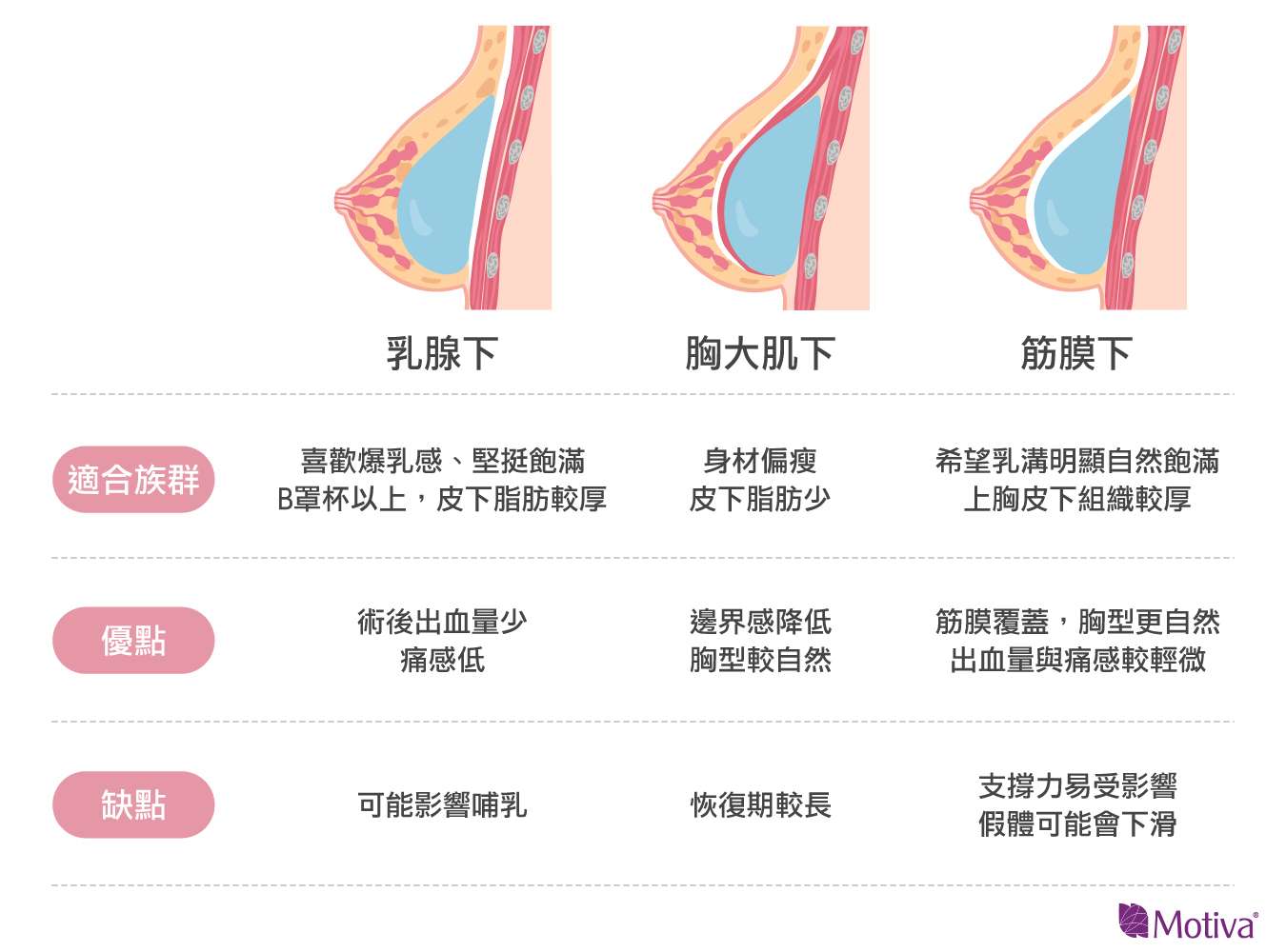 隆乳手術魔滴放在胸大肌、筋膜下、乳線下的圖說