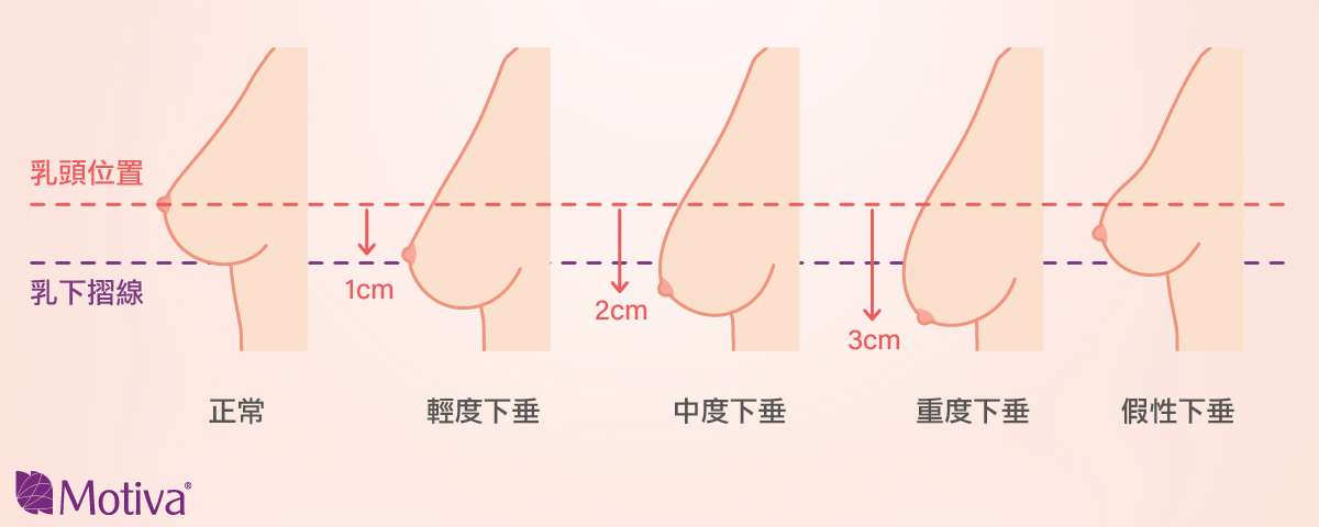 乳房下垂程度手繪圖