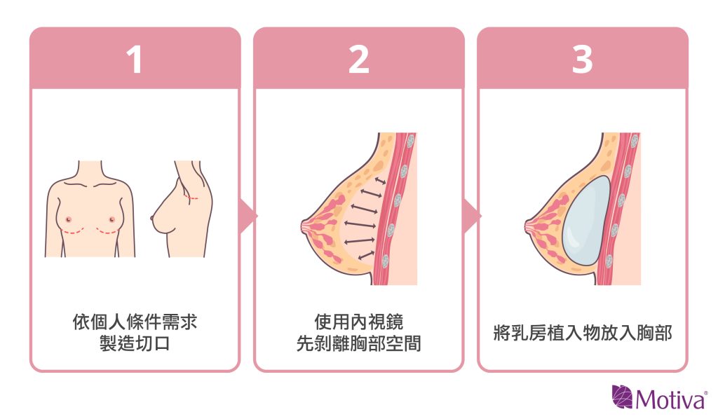 什麼是假體隆乳手術圖說