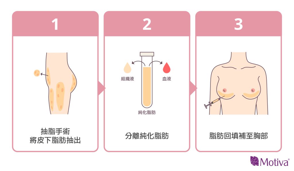 自體脂肪隆乳圖說