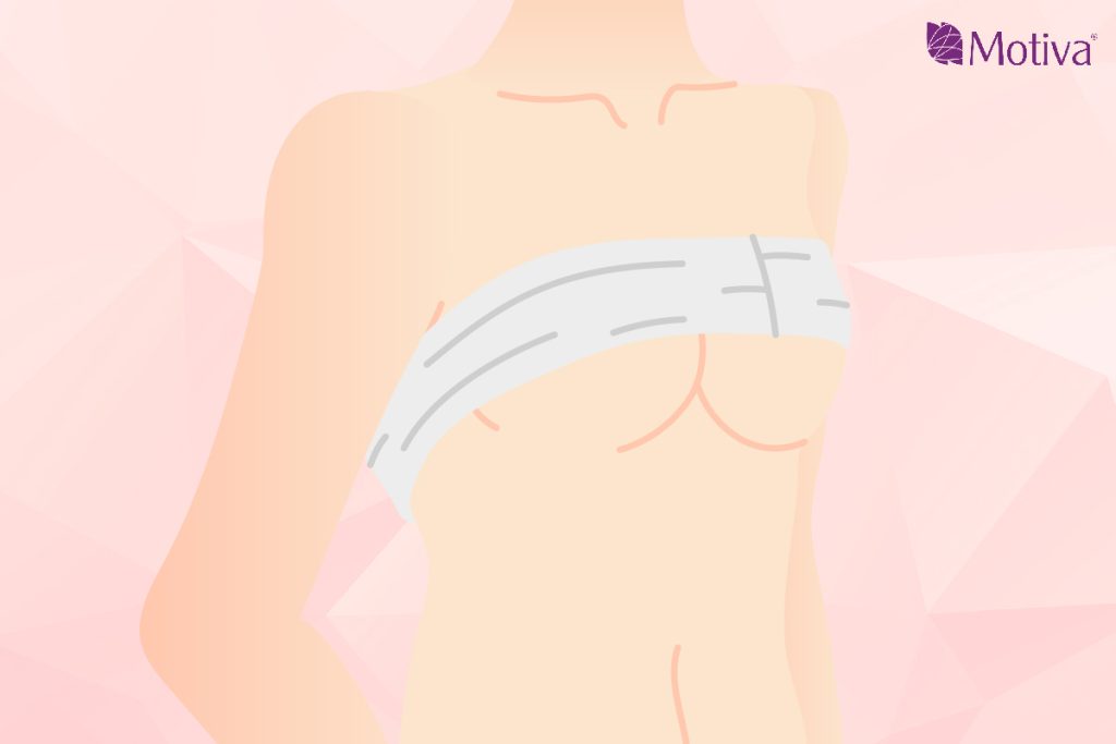 隆乳術後穿繃帶