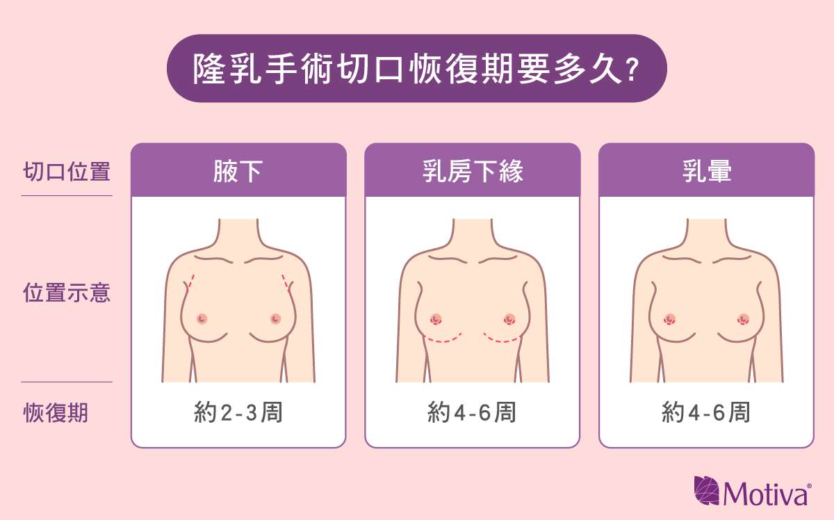 隆乳手術切口恢復時間：腋下、乳房下緣、乳暈