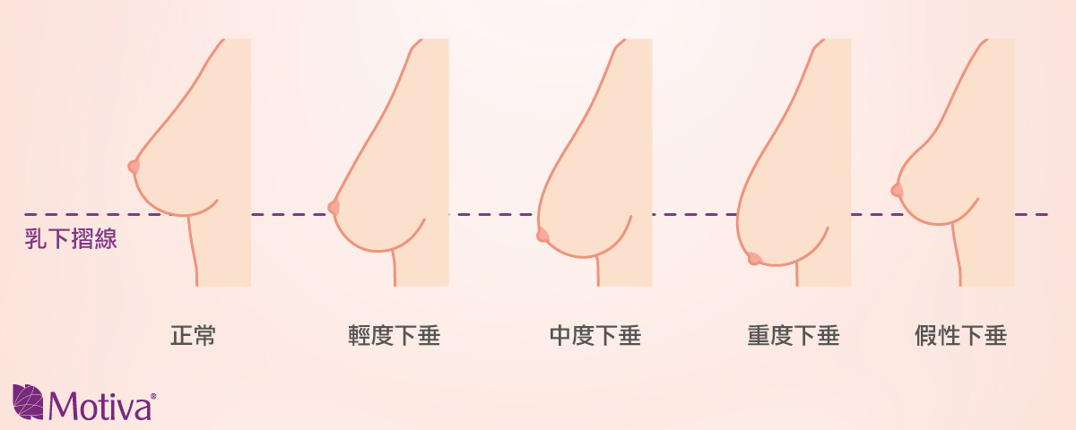 你有胸部下垂嗎