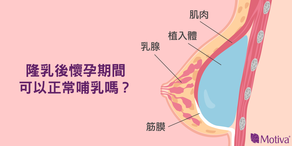 植入物放置位置不會影響哺乳