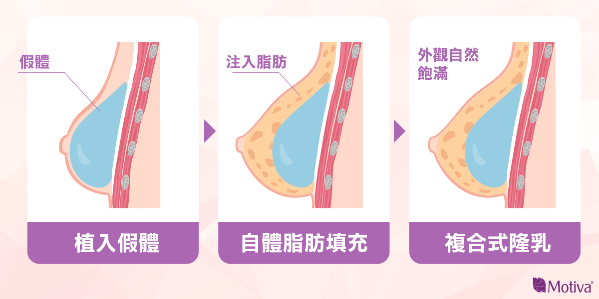 隆乳手術後想要擁有自然的乳溝，該怎麼做？
