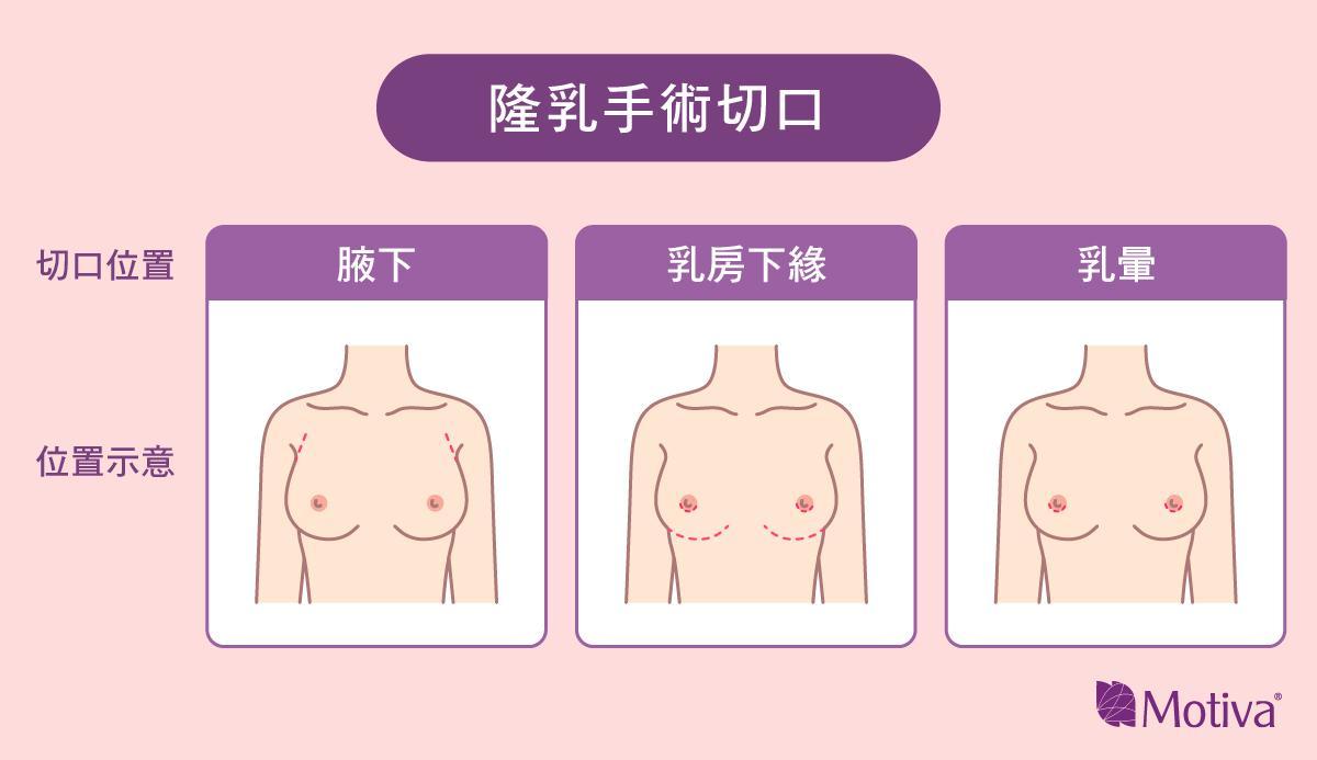 隆乳傷口