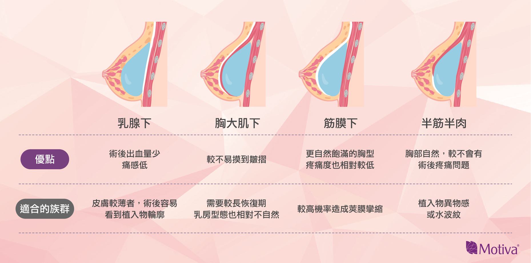 隆乳植入物可選擇置於乳腺下、筋膜下、胸大肌及半筋半肉四個位置