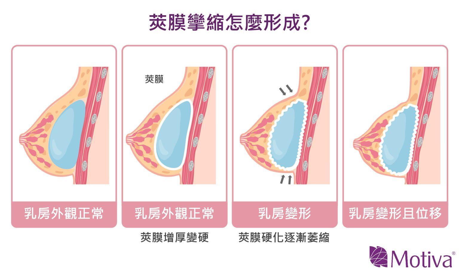 莢膜攣縮