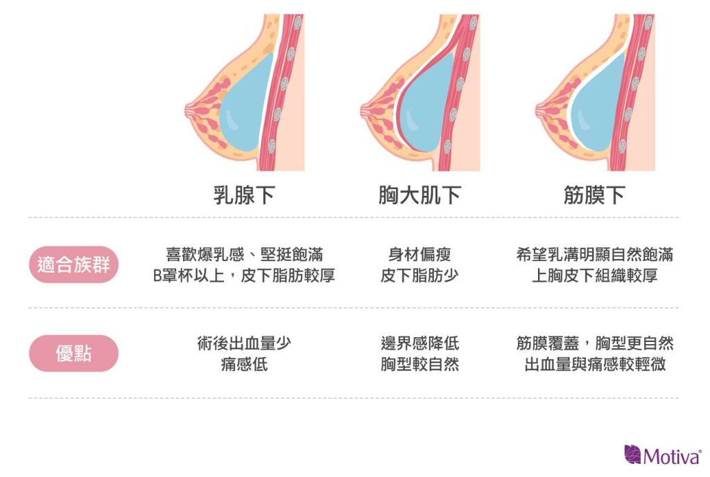 假體位置